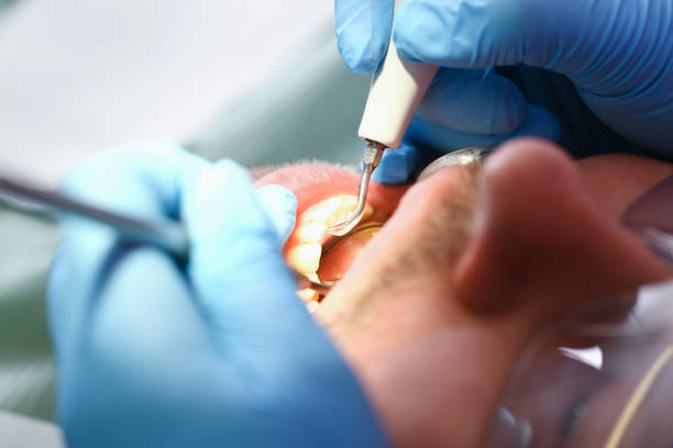 Best Emergency Tooth Extraction in Slippery Rock University, PA